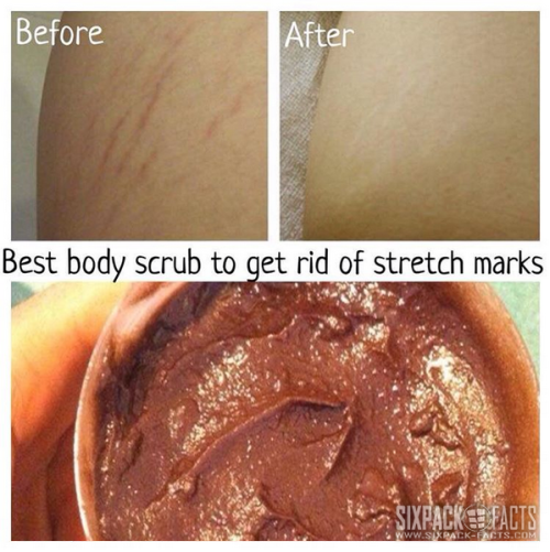 Best Body Scrub To Get Rid Of Stretch Marks