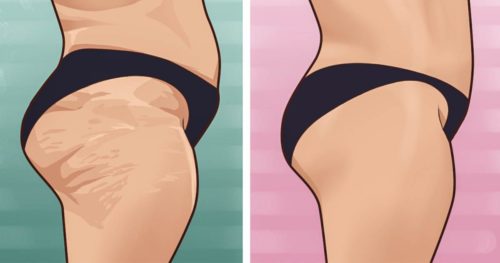 Ways to reduce the appearance of cellulite