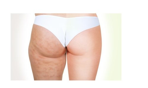 3 Best Exercises To Target Butt Cellulite